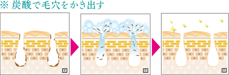炭酸で毛穴をかき出すの図